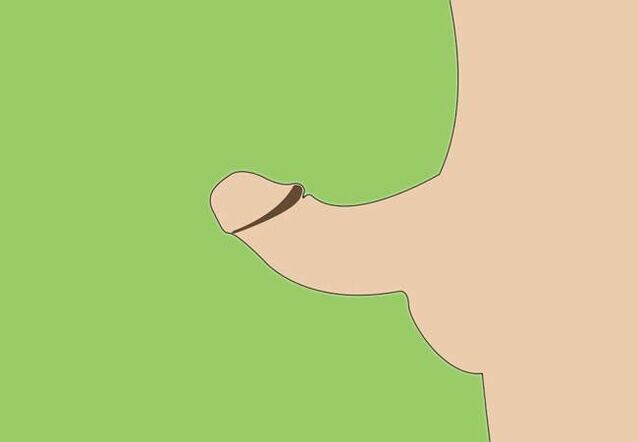 penile curvature as an indicator of surgical enlargement