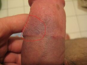 hematoma in the penis due to improper use of the pump